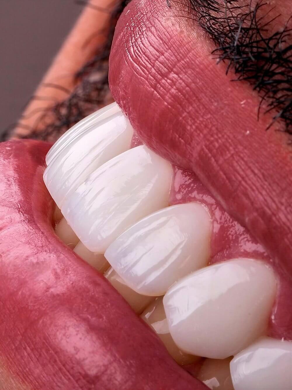 Smile Dental Miami - Porcelain Veneers