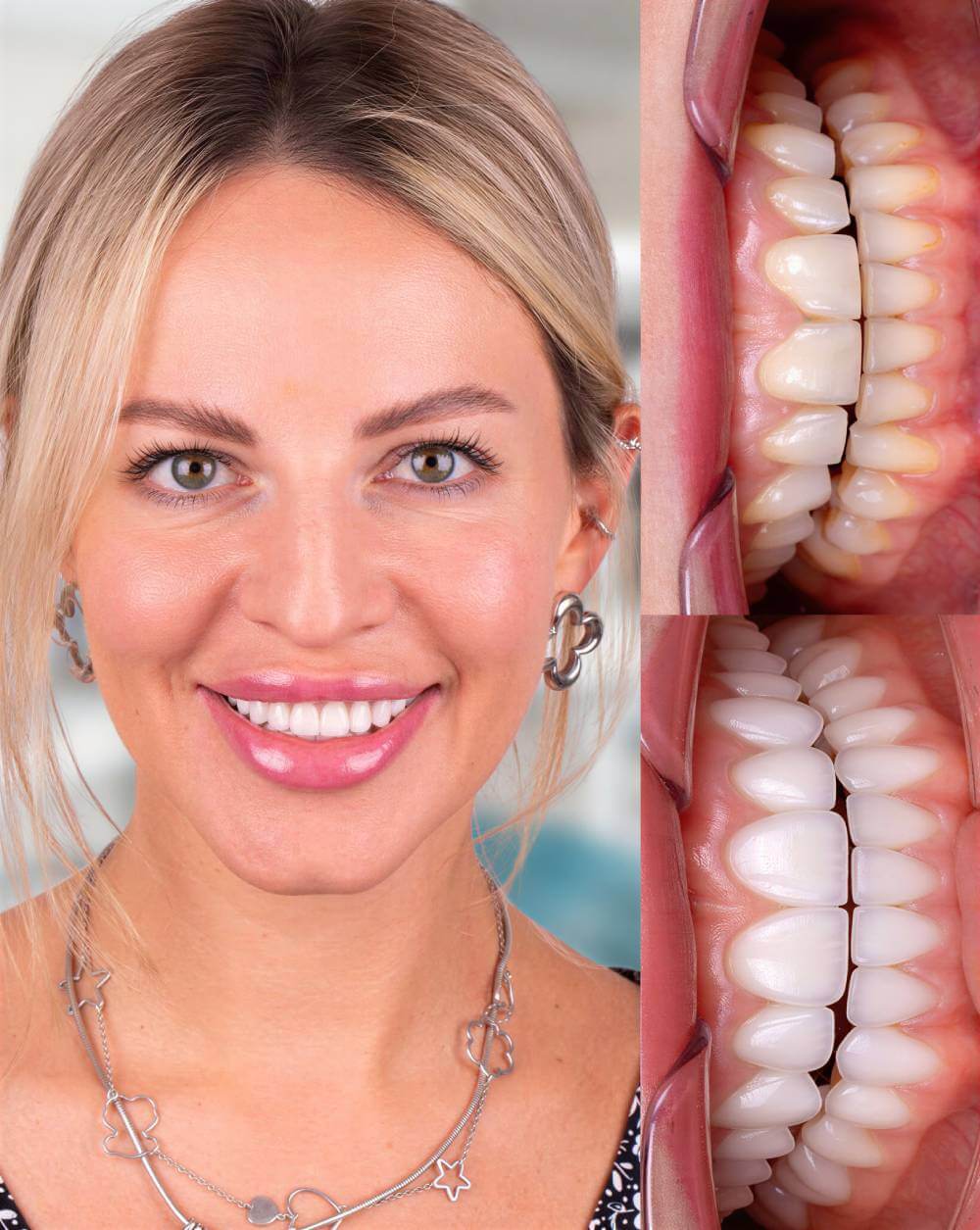 Smile Dental Miami - Porcelain Veneers Case 13