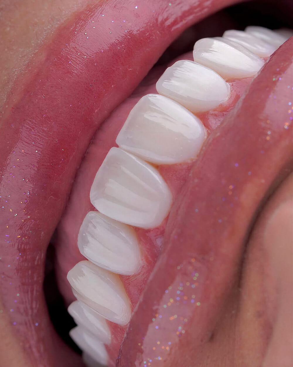 Smile Dental Miami - Porcelain Veneers Case 14