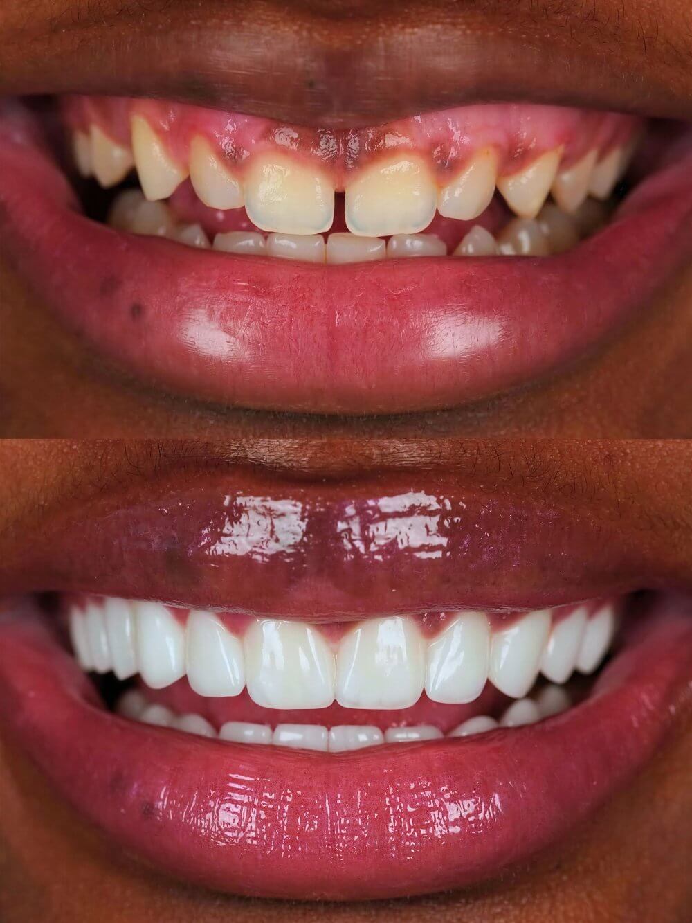 Smile Dental Miami - Porcelain Veneers