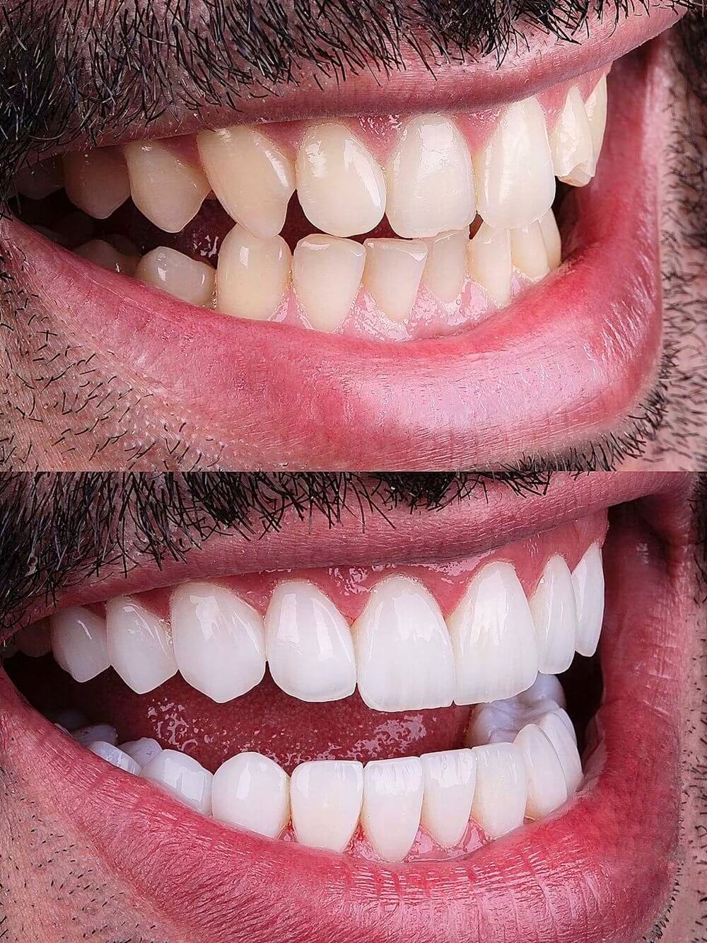 Smile Dental Miami - Porcelain Veneers