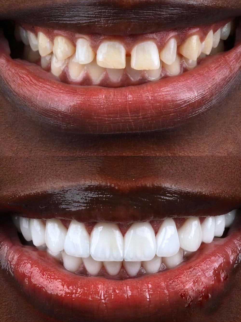 Smile Dental Miami - Porcelain Veneers