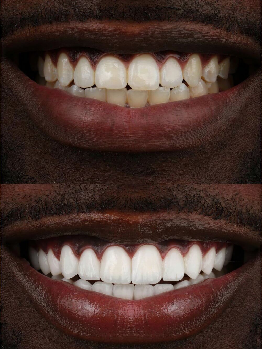 Smile Dental Miami - Porcelain Veneers Case 1